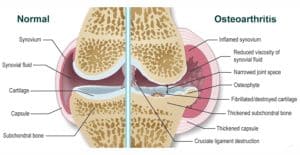Comparison of a healthy joint and a joint affected by arthritis in dogs, showing cartilage damage, inflammation, and narrowed joint space.