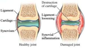 Illustration of arthritis in dogs comparing a healthy joint and a damaged joint with inflamed synovium and destroyed cartilage.